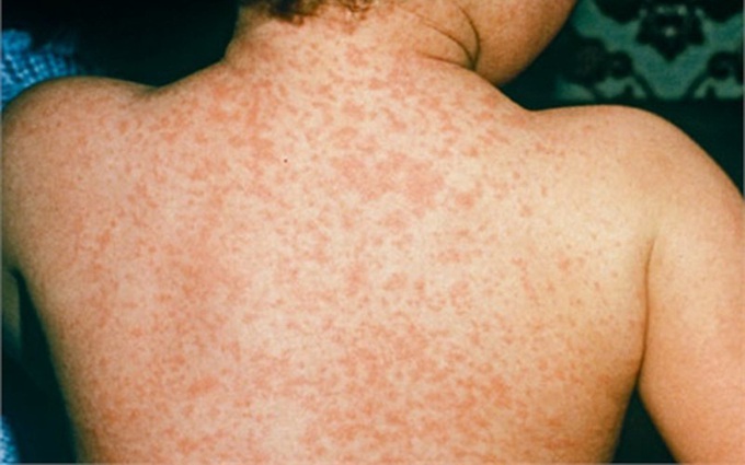 Chẩn đoán và xử lý kịp thời khi bị sốt phát ban do bệnh Rubella