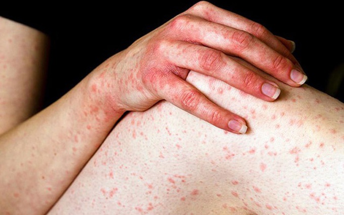 Tìm hiểu 10 bệnh ngứa ngoài da vào mùa hè thường gặp