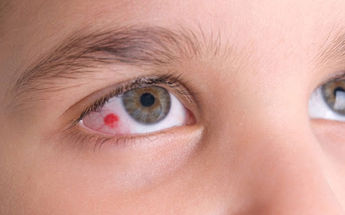 Mắt bị đỏ tròng trắng là gì? Những thông tin về mắt bị đỏ tròng trắng người bệnh nên biết