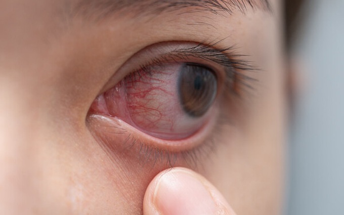 Mắt bị nổi gân máu đỏ là bệnh gì? Có nguy hiểm không?