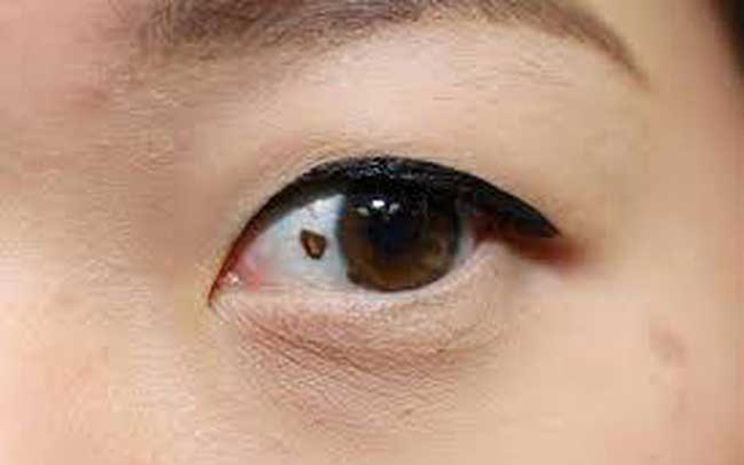 Ung thư mắt là gì? Những điều cần biết về ung thư mắt
