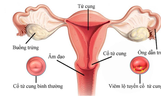 Viêm lộ tuyến cổ tử cung là gì? Những điều cần biết về bệnh viêm lộ tuyến cổ tử cung