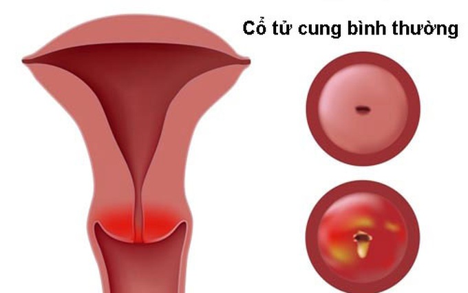 Thông tin từ A đến Z về bệnh viêm cổ tử cung