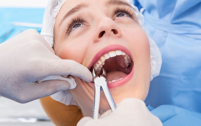Vì sao phải nhổ răng khôn? Nhổ răng khôn bao lâu thì lành?