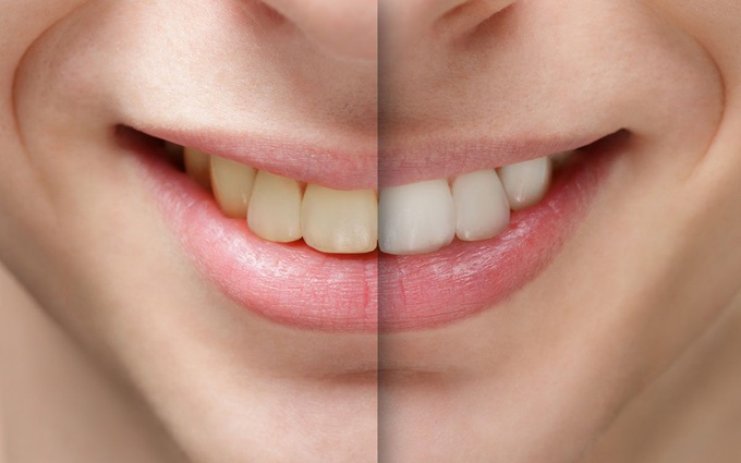 Tổng hợp những nguyên nhân răng bị xỉn màu