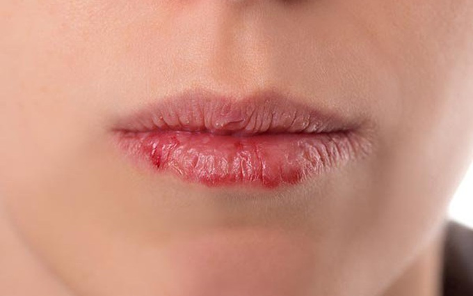 4 đặc điểm trên mặt bất thường cho thấy chị em đang mắc bệnh phụ khoa