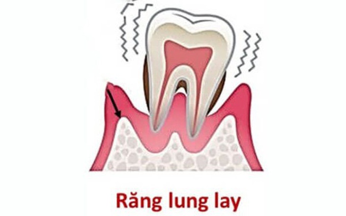 Răng vĩnh viễn bị lung lay: Nguyên nhân và biện pháp khắc phục