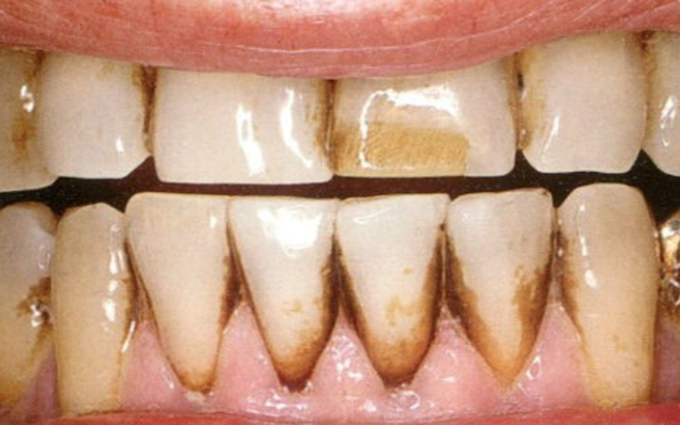 Kẽ răng bị đen do đâu và cách điều trị an toàn