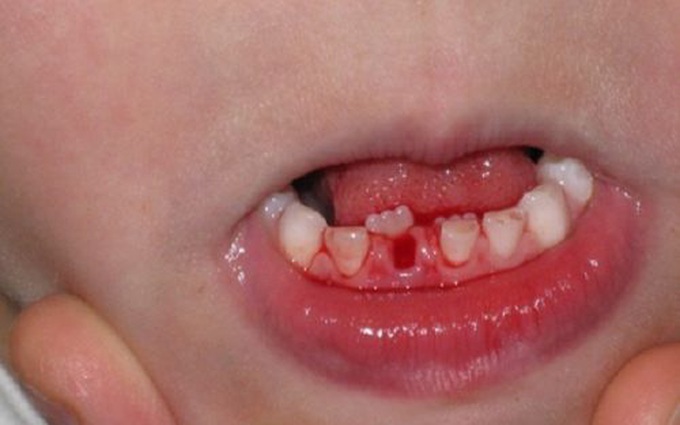 Răng không đều phải làm sao? Gợi ý cách chỉnh nha để có hàm răng đẹp