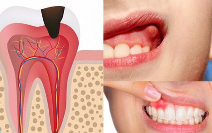 Phẫu thuật cắt chóp răng là gì? Cắt chóp răng có nguy hiểm không và bao lâu thì lành?