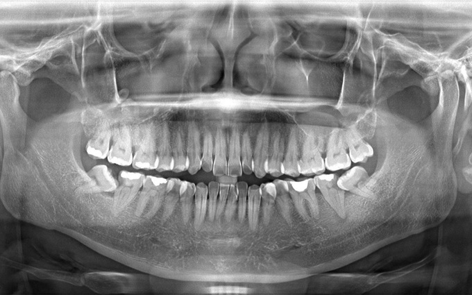 Tìm hiểu về chụp X quang răng và những điều cần lưu ý