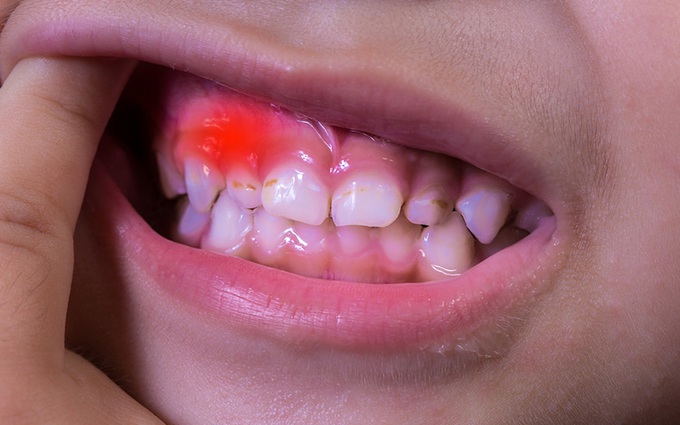 Phụ huynh cần biết gì về tình trạng viêm nướu răng ở trẻ em?
