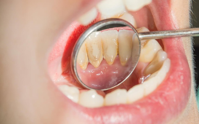Gợi ý 6 cách lấy cao răng tại nhà một cách tự nhiên và an toàn