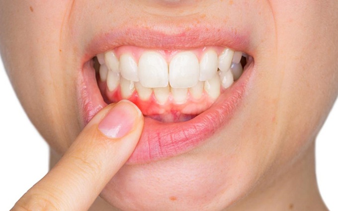Cách chữa viêm lợi chân răng và những lưu ý trong điều trị