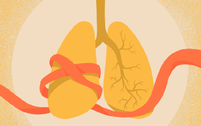 Nhiễm trùng đường hô hấp dưới: Yếu tố nào làm tăng nguy cơ mắc bệnh?