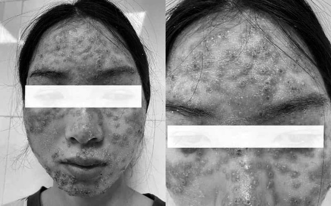 'Detox' da tại spa, cô gái bị bội nhiễm da Eczema herpeticum