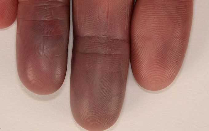 Tìm hiểu về hội chứng Raynaud khiến tay bị tím tái, đau buốt vào mùa đông