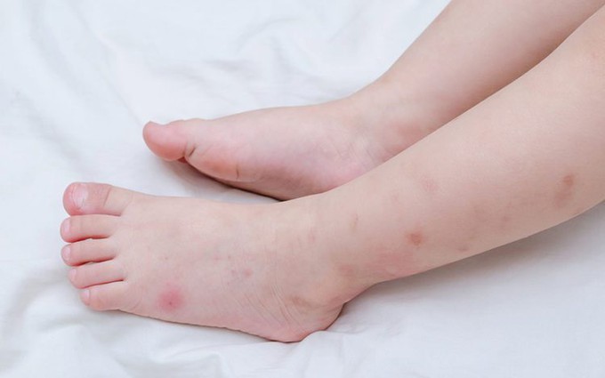 Da bị nổi mẩn đỏ ngứa như muỗi đốt là bệnh gì? Nguyên nhân và cách điều trị