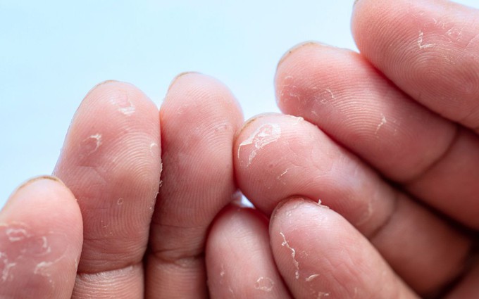 Bong tróc da đầu ngón tay: Nguyên nhân, cách điều trị và phòng ngừa