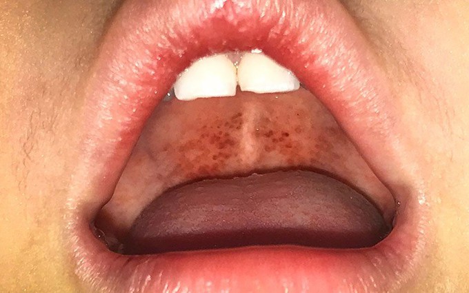 Đốm đỏ trên vòm miệng là do đâu? Nguyên nhân và cách điều trị