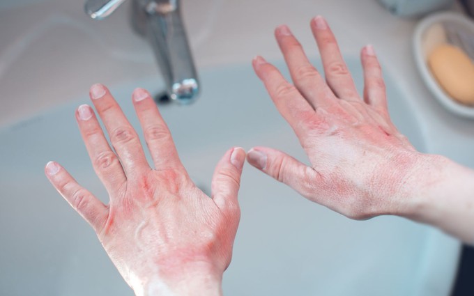 Phát ban do rửa tay: 5 nguyên nhân cần chú ý