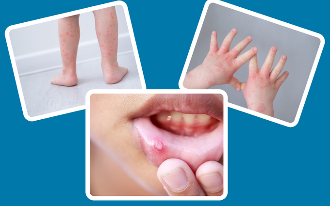 Những dấu hiệu khỏi bệnh tay chân miệng và cách chăm sóc trẻ sau khi khỏi bệnh