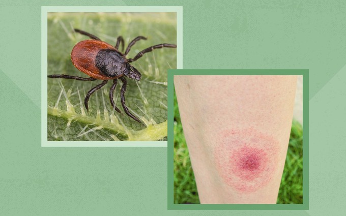 10 bệnh lý lây truyền từ bọ ve mà mọi người cần cẩn trọng