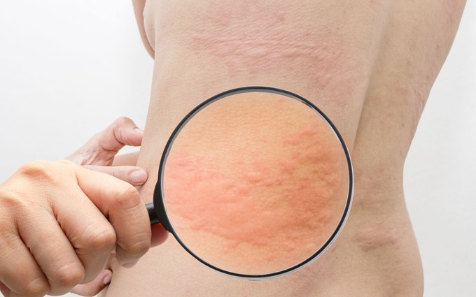 Giao mùa bị nổi mề đay nên làm gì để giảm ngứa mề đay nhanh tại nhà?