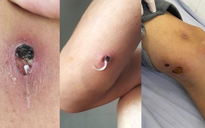 Giun rồng là giun gì? Bệnh giun rồng có chữa khỏi được không?