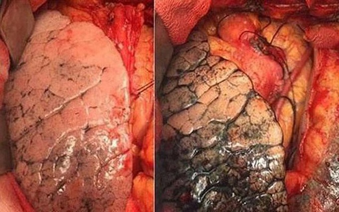 Cách phát hiện sớm bệnh ung thư phổi