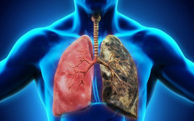Khi nào cần tầm soát ung thư phổi?