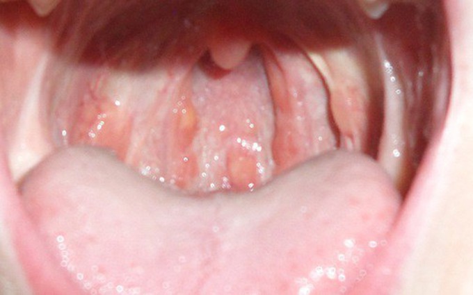Các vết loét họng và miệng: dấu hiệu của bệnh ung thư, cách chẩn đoán và điều trị