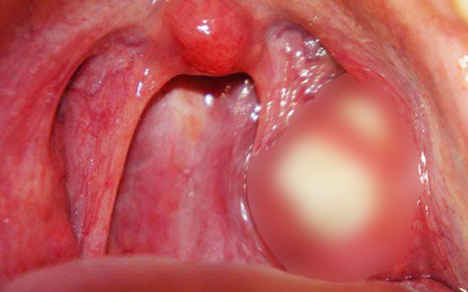 Hạt trắng trong miệng là bệnh gì? 