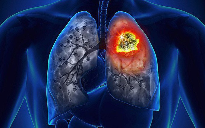 Ung thư phổi khó phát hiện do đâu? Dấu hiệu, nguyên nhân chính và khả năng điều trị bệnh