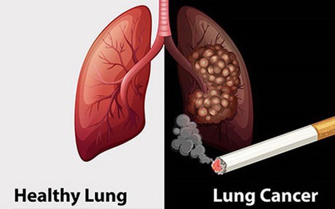 Kiểm soát những dấu hiệu của bệnh ung thư phổi để tăng hiệu quả điều trị