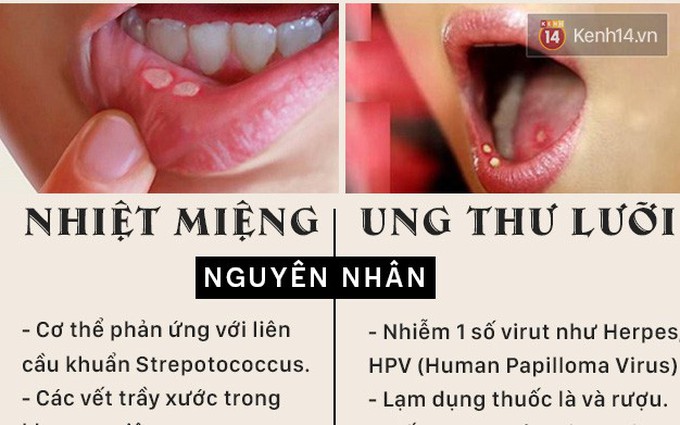 Nhiệt miệng và ung thư lưỡi: Triệu chứng dễ nhầm lẫn, làm thế nào để phân biệt?
