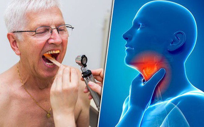 Khả năng chữa trị của ung thư vòm họng giai đoạn 2 là bao nhiêu phần trăm?