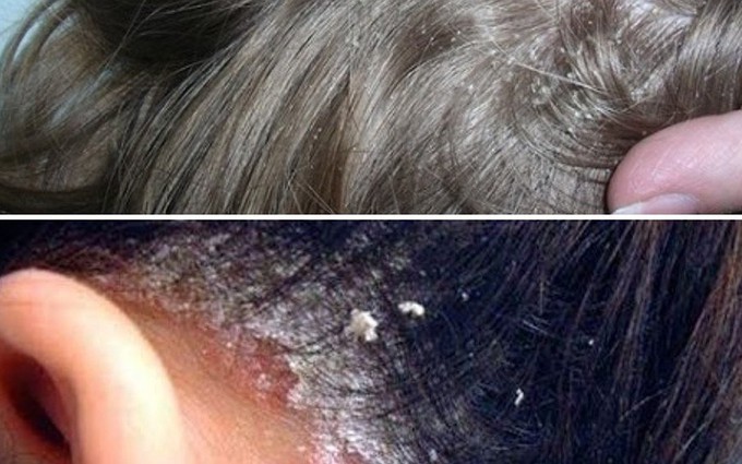 5 bí kíp trị nấm da đầu hiệu quả từ thiên nhiên