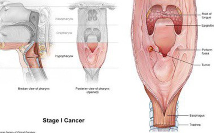 Các giai đoạn của ung thư thanh quản 