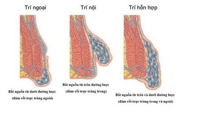 3 địa chỉ phẫu thuật cắt trĩ hiệu quả nhất tại Hà Nội