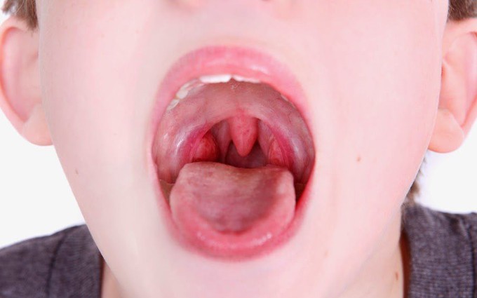 Trẻ em viêm họng chăm sóc thế nào?