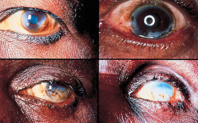 Sốc: 10 bệnh ký sinh trùng ở mắt có thể gây mù vĩnh viễn