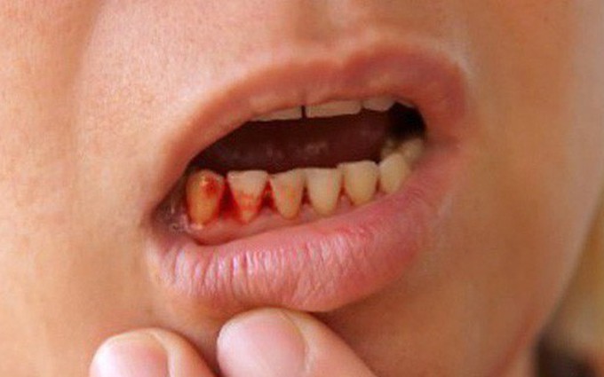 Chảy máu chân răng là dấu hiệu của bệnh gì?