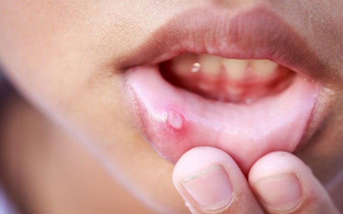 Ung thư miệng: dấu hiệu, nguyên nhân, cách điều trị và phòng tránh
