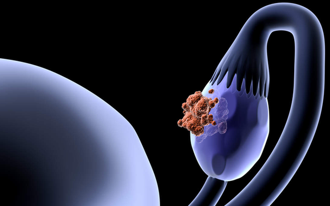 Ung thư buồng trứng: Nguyên nhân, triệu chứng, các giai đoạn, chẩn đoán và điều trị