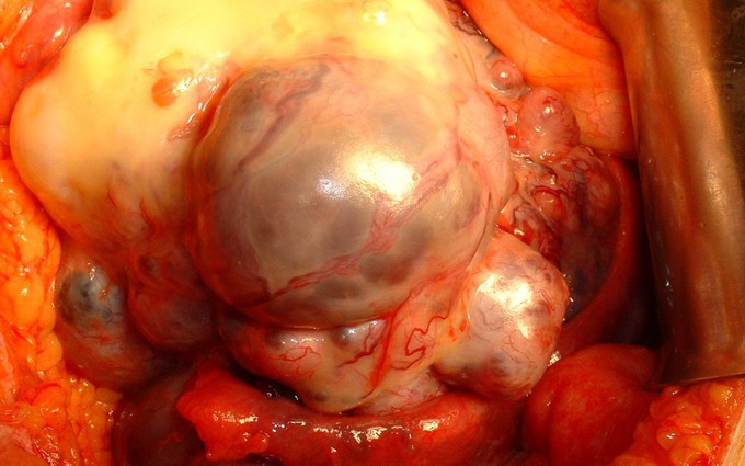 Các giai đoạn của ung thư buồng trứng