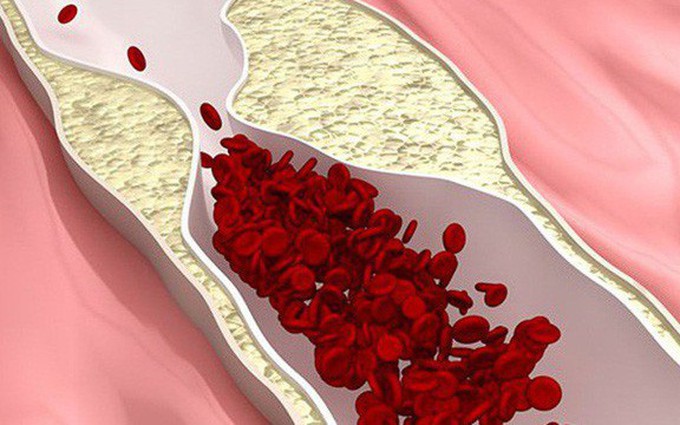 Những phương pháp 'làm sạch' mạch máu: người già hay người trẻ đều cần biết