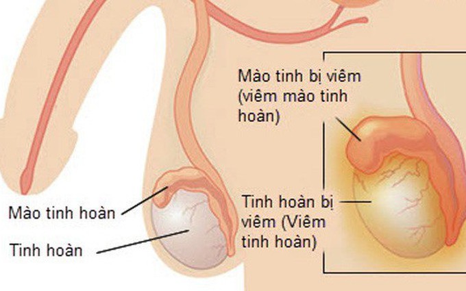 Viêm mào tinh hoàn nguy hiểm như thế nào? 