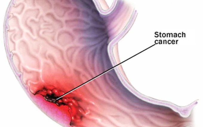 Giới thiệu các biến chứng bệnh đau dạ dày