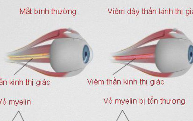  Viêm dây thần kinh thị giác là gì?